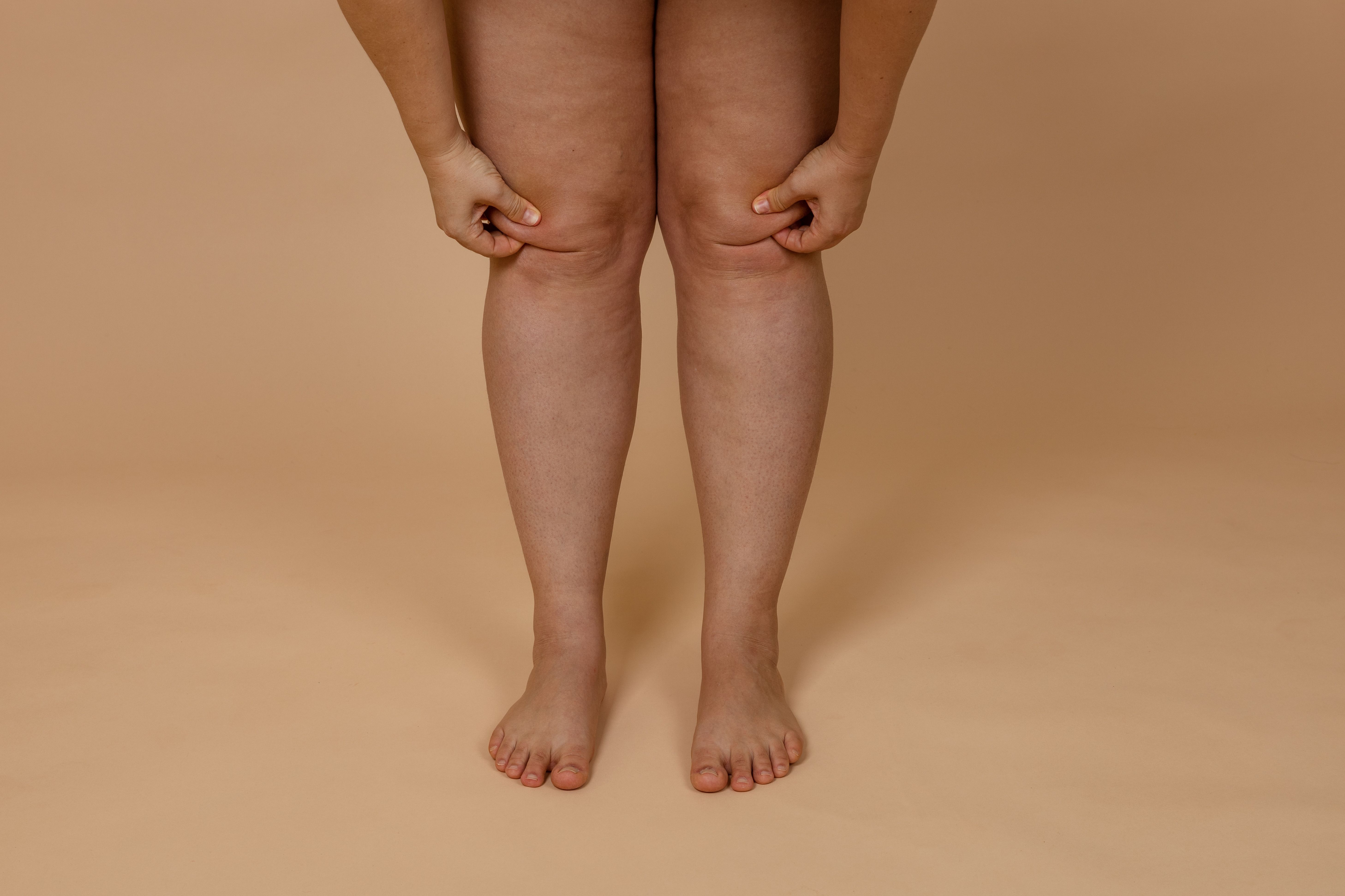 knee liposuction:liposuction:plasticsurgeon.jpg